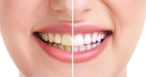 How long does teeth whitening last?